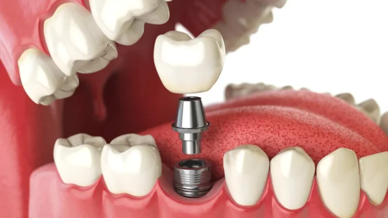 Cosmetic Implant Dentistry