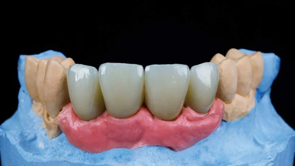 front dental implants