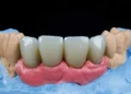 front dental implants