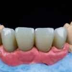 front dental implants