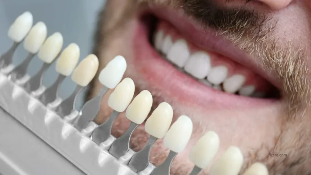 Porcelain Veneers