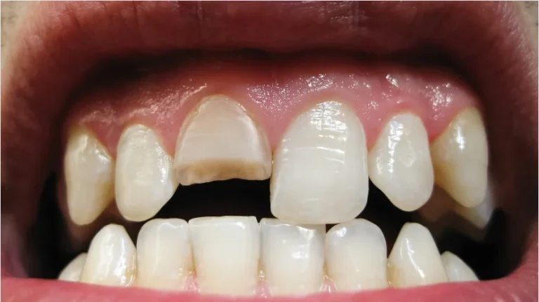Chipped Tooth