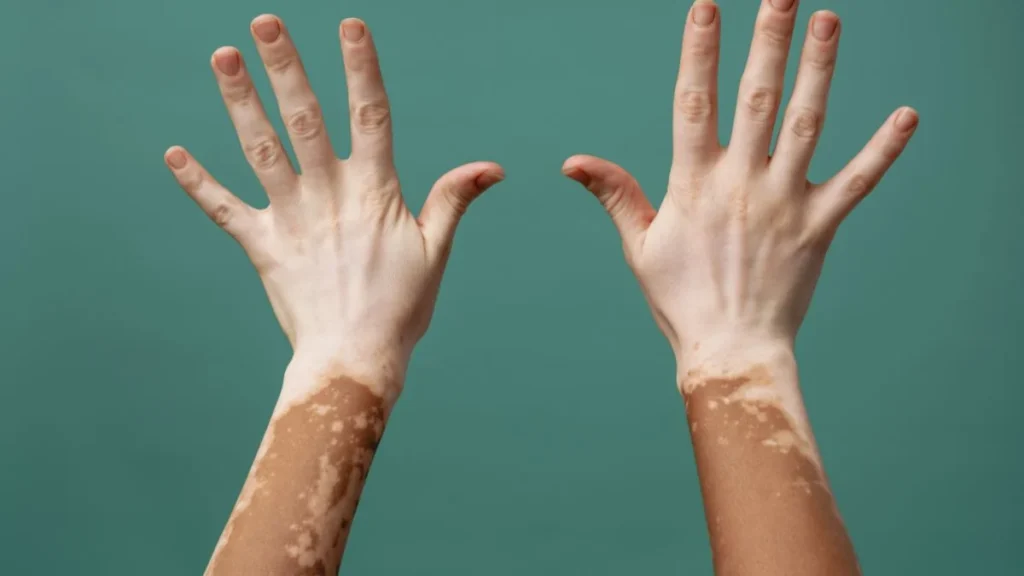 Vitiligo