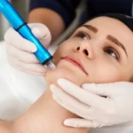 RF Microneedling