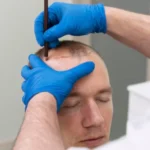 Scalp MicroPigmentation