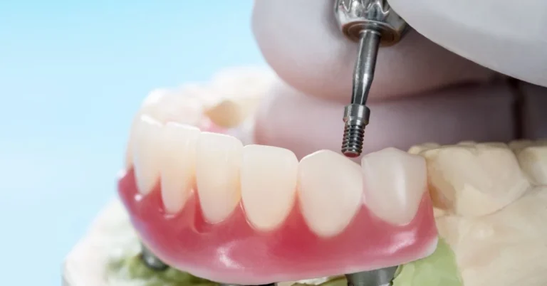 Dental Implant