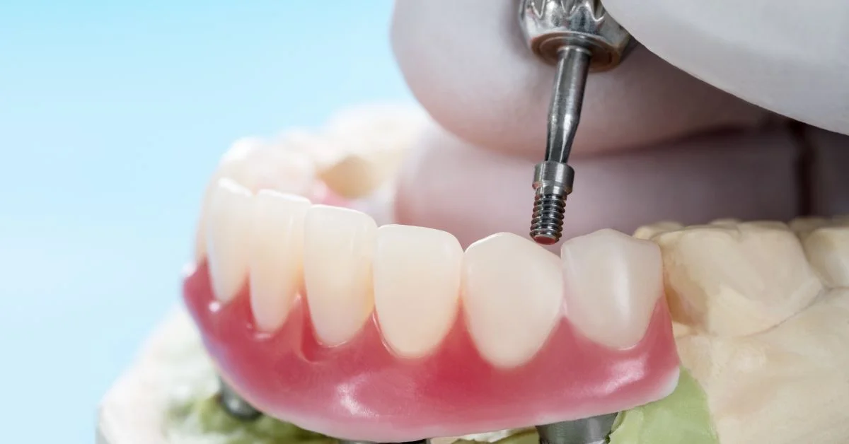 Dental Implant