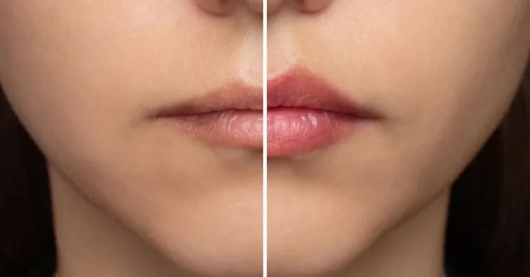 Lip Filler