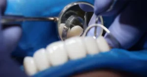 A zirconia bridge is a fixed dental prosthesis designed to replace one or more missing teeth.