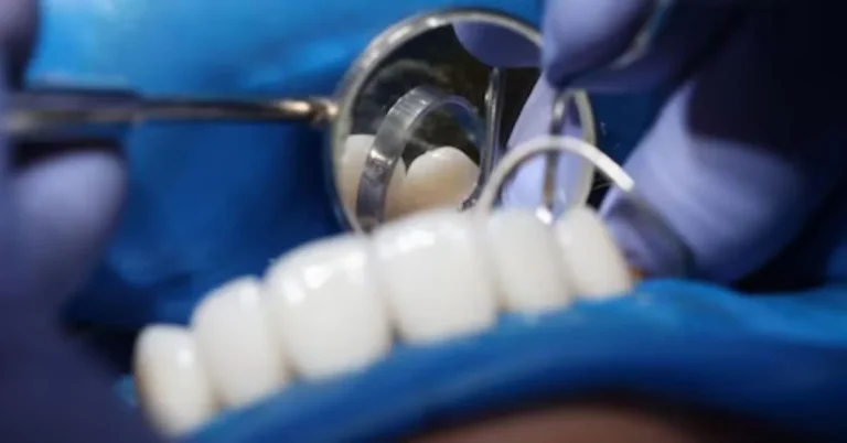 A zirconia bridge is a fixed dental prosthesis designed to replace one or more missing teeth.