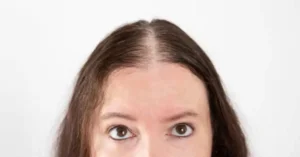 Lowering forehead surgery is a cosmetic procedure that reduces the vertical height of the forehead by bringing the hairline forward.
