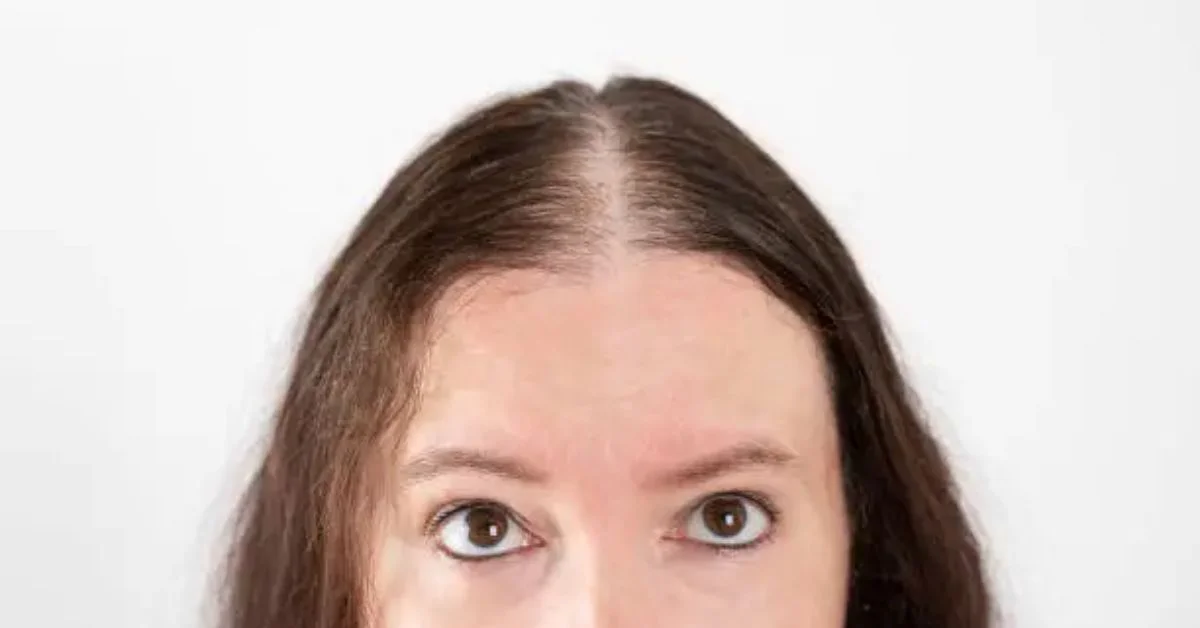 Lowering forehead surgery is a cosmetic procedure that reduces the vertical height of the forehead by bringing the hairline forward.