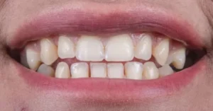 Bridge Teeth