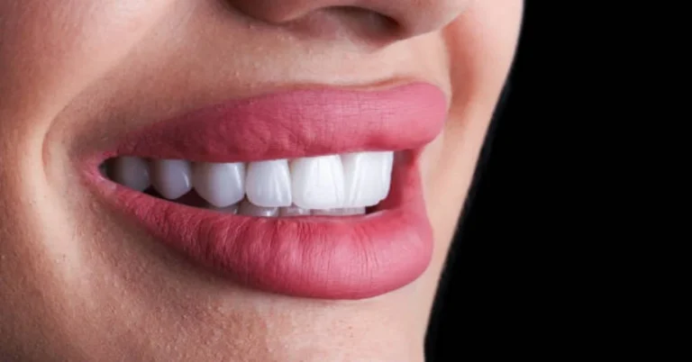 Veneers